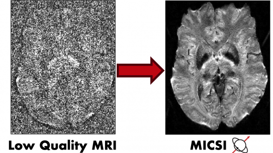 a comparison between a low quality MRI and MICSI