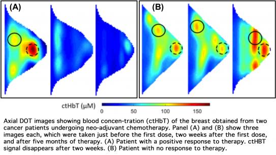 Axial DOT images showing blood concen-tration (CtHbT) of the breast obtained from two cancer patients undergoing neo-adju-vant chemotherapy