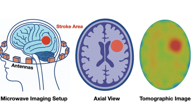 Three images of a brain, one with magnets surrounding it, one illustration with a red spot, and one CT scan with a hemorrhage marked in red.
