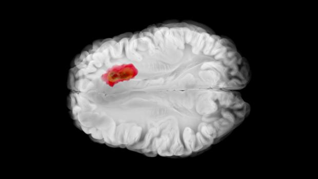 A brain scan with a tumor highlighted red