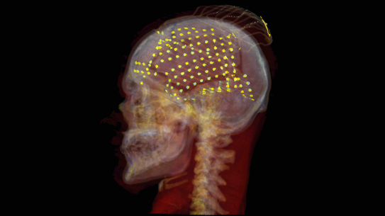 X-ray of skull with EEG nodes highlighted in yellow