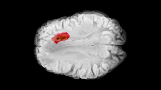 A brain scan with a tumor highlighted red