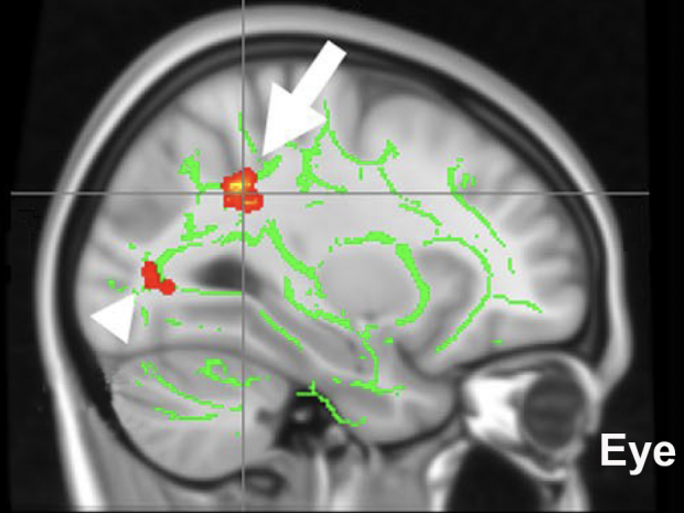 MRI coronal cross-section through the human head