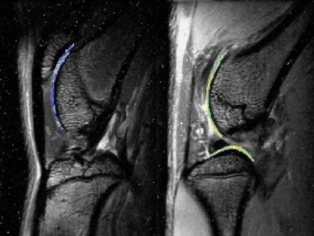 Imaging of osteoarthritis in the knee