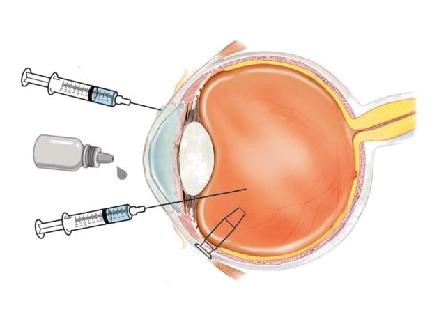 A Journey of STAR-DDS:  Anti-VEGF Drug Delivery System for the Eye