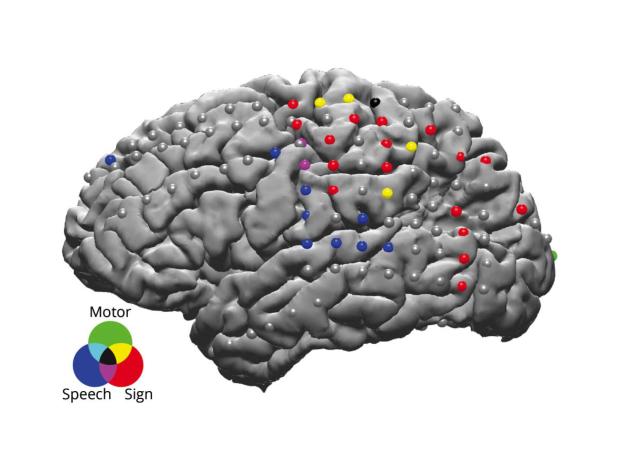 Greyed out Brain scan with a map of electrodes 
