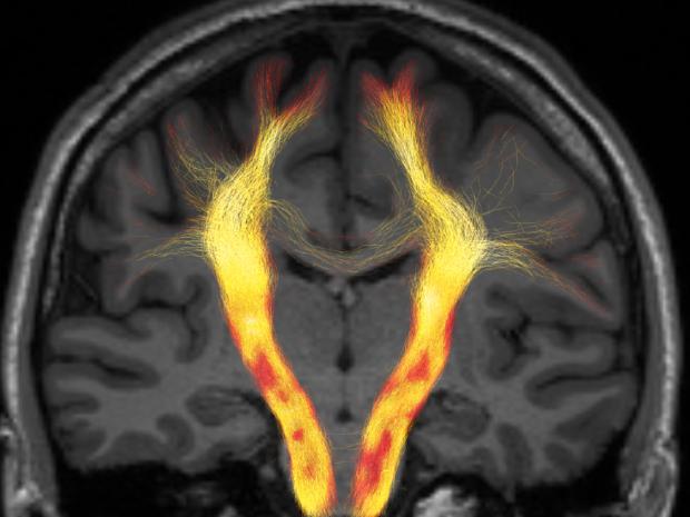 MRI image of white matter connectivity within the brain