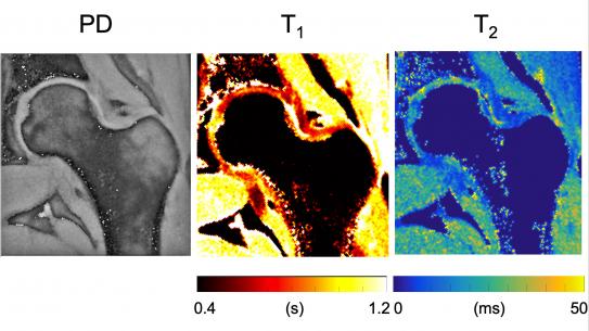 MR fingerprinting: Simultaneous Proton Density (PD), T1 and T2 maps of the hip articular cartilage.