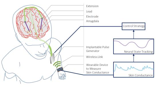 A conceptual close-loop deep brain stimulation (CLDBS) architecture 