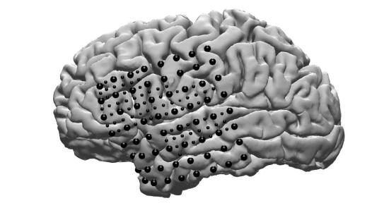 black and white image of brain with 45 black dots placed on it.