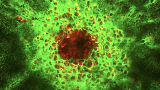 Label-free nonlinear microscopy: A tumor spheroid composed of MDA-MB-231 breast cancer cells showing collagen (green) and the metabolic cofactor NADH (red).