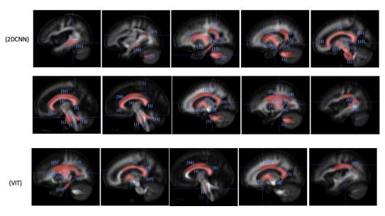 White matter regions in selected MRI slices