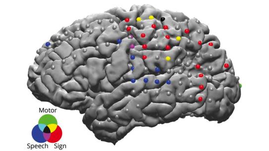 Greyed out Brain scan with a map of electrodes 